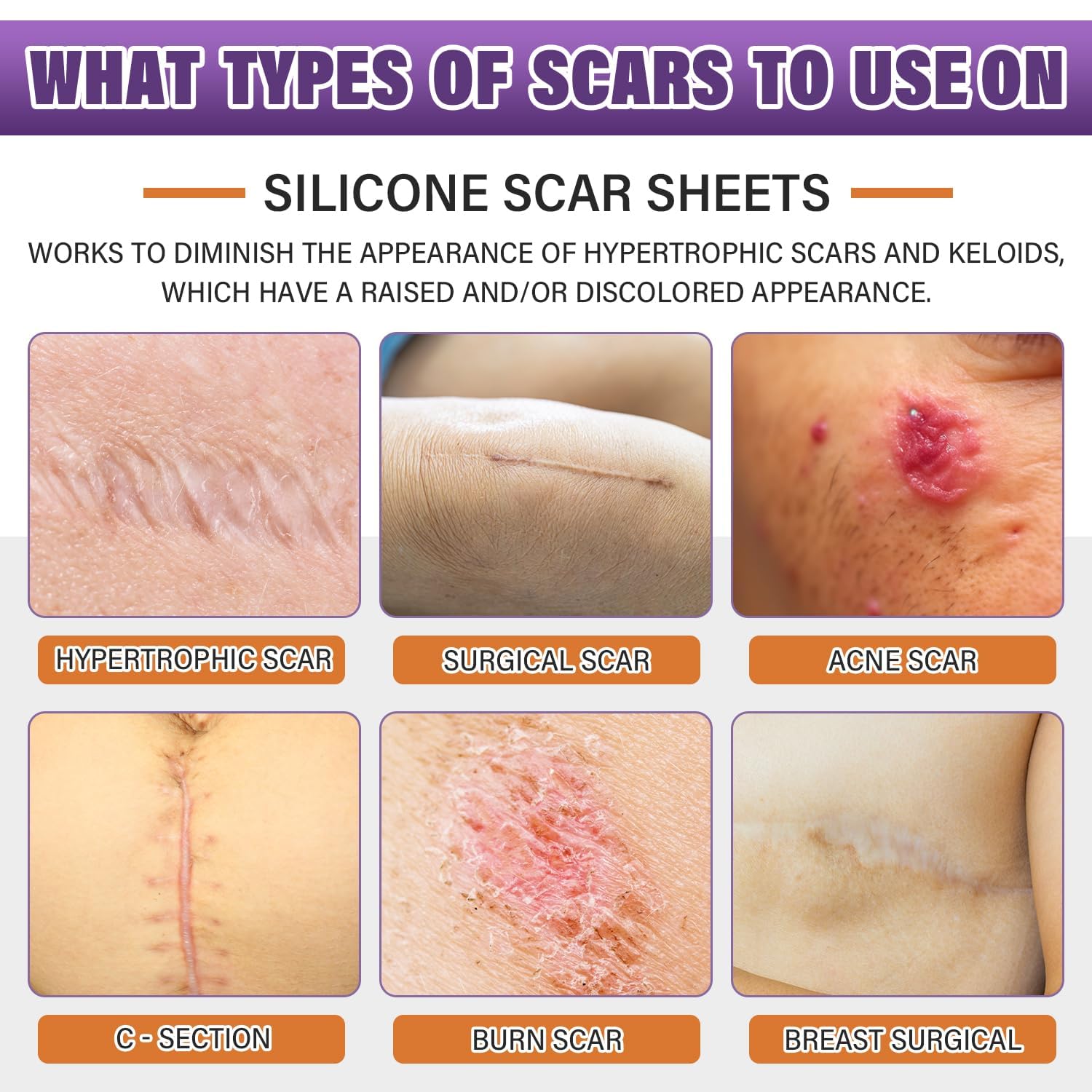 Medical-Grade Silicone Scar Sheets - Reduce Surgical Scars from Cancer Treatment (Reusable)